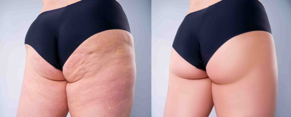 Sculptra Injections for Hip Dips Treatments in Queens, NY