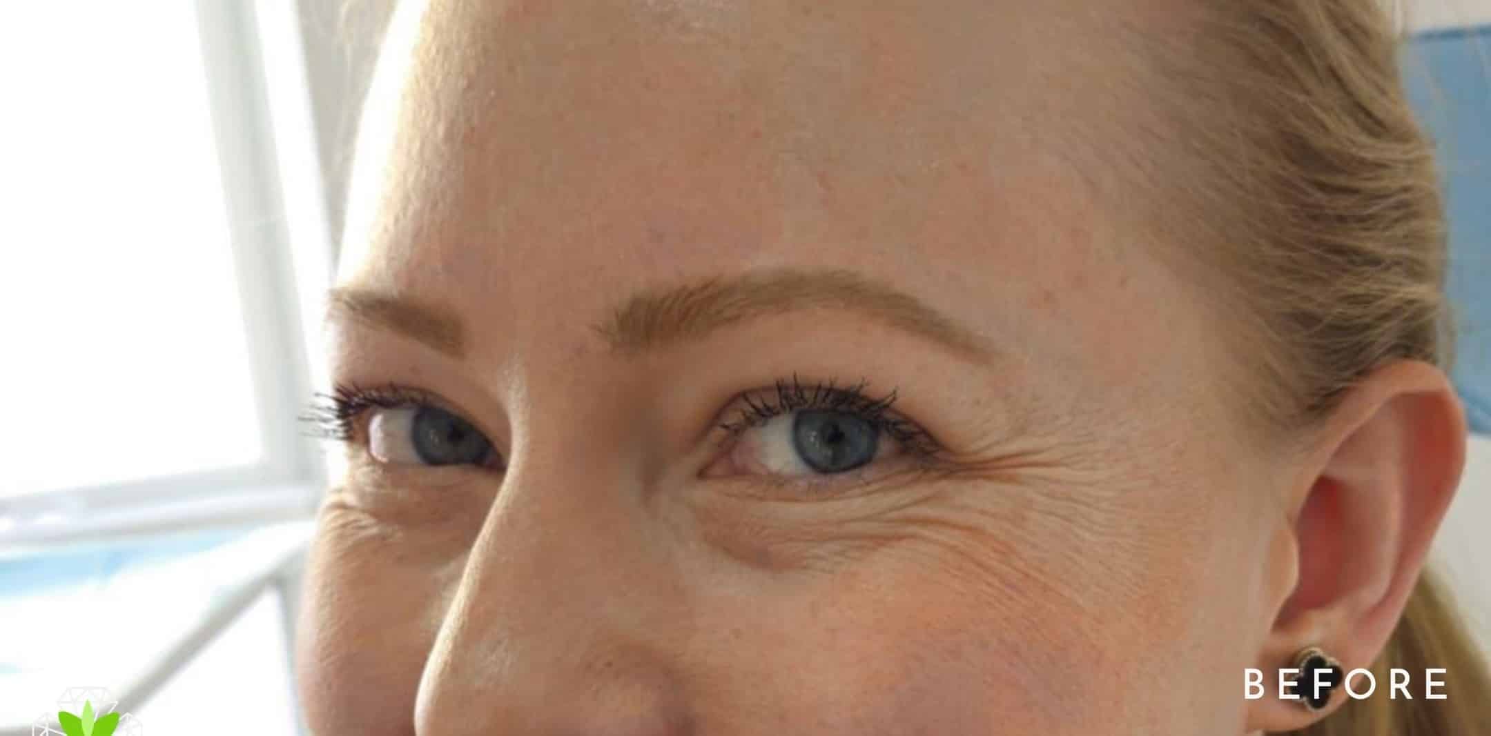 Before Image: Botox - left-front-oblique