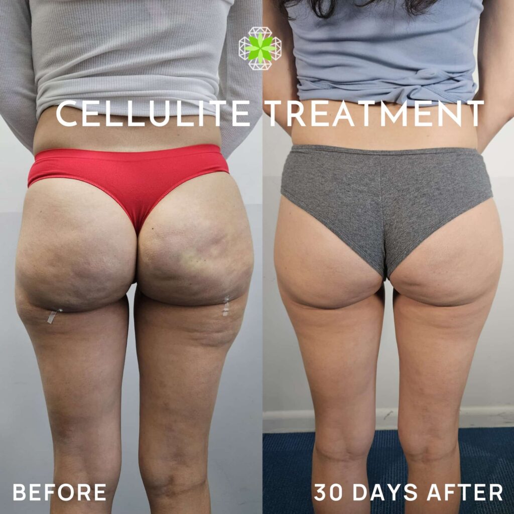 Cellulite-before-and-after-1